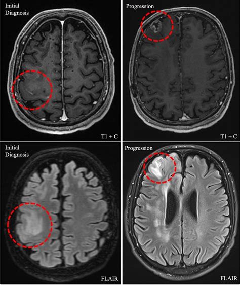 the villages brain mri with contrast|MRI with vs. without Contrast: A Patient’s Guide.